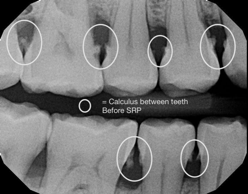 What Are Deep Cleanings And Why Is The SRP So Misunderstood?