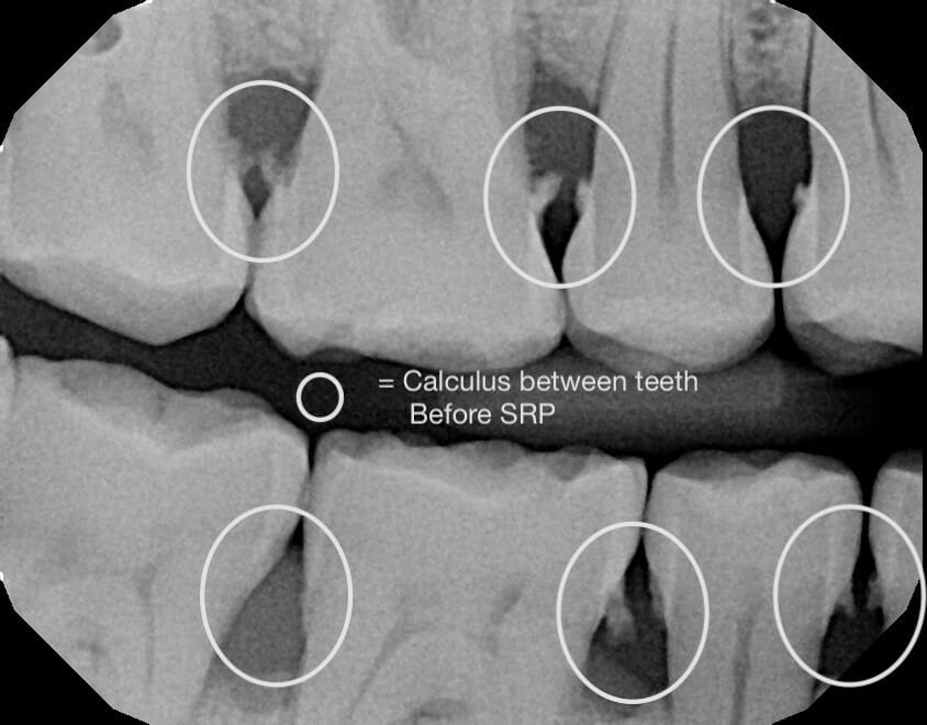 Dental Deep Cleaning (SRP)