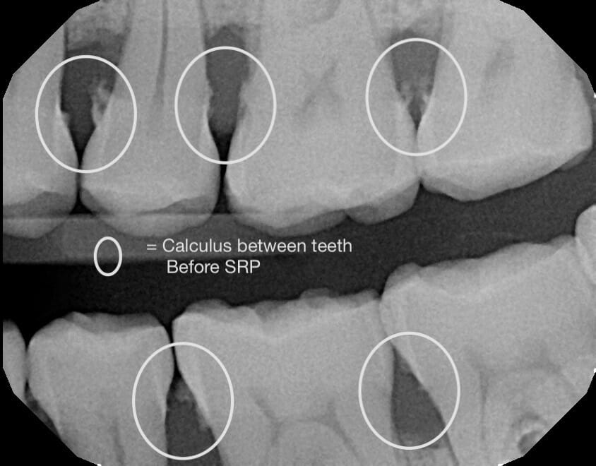 Signs You Need a Deep Dental Cleaning