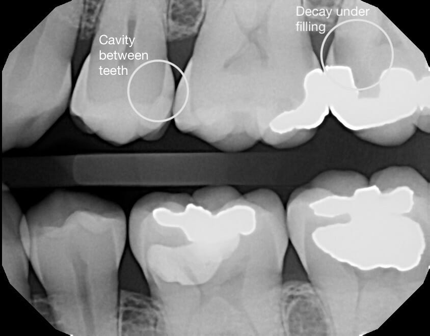 The Top 5 Reasons Why you Need Dental XRays